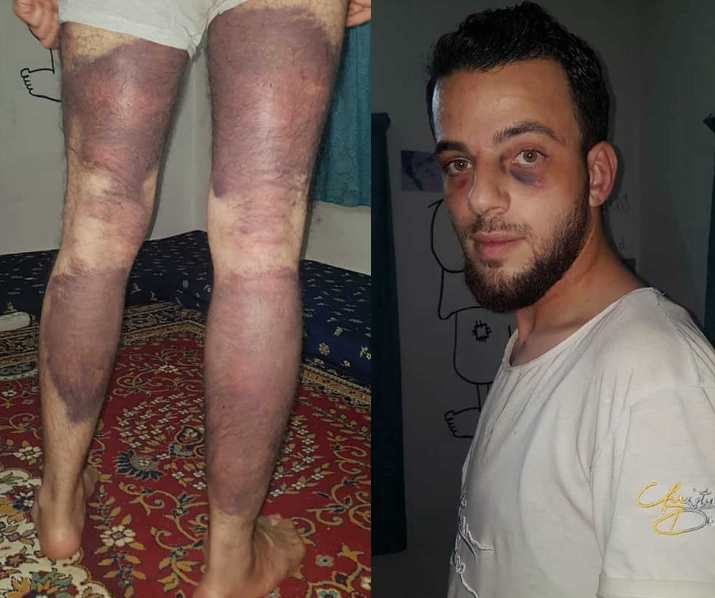 بعد الإفراج عنه.. “بلال سريول” يكشف لحلب اليوم تفاصيل اعتقاله وتعذيبه من قبل فصيل السلطان مراد