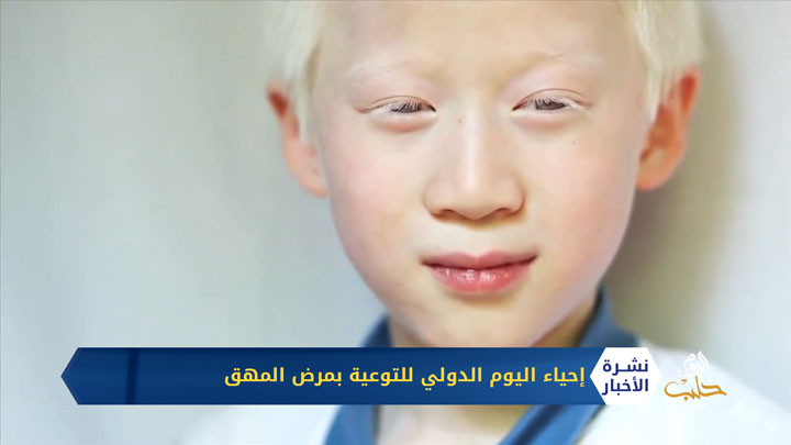 إحياء اليوم الدولي للتوعية بمرض المهق