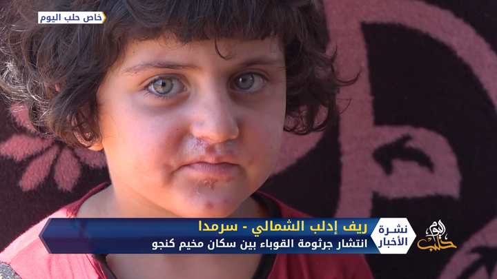 جرثومة خطيرة ومعدية تفتك بجلد الإنسان تنتشر في أحد مخيمات إدلب