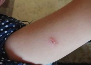 آلاف إصابات “اللشمانيا” بريف دير الزور