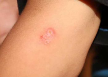 بسبب الإهمال.. آلاف الإصابات بـ”اللشمانيا” في الطبقة بريف الرقة