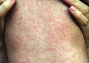 ريف حلب.. تسجيل عشرات الإصابات بمرض “الحصبة” في مدينتي الباب وعفرين