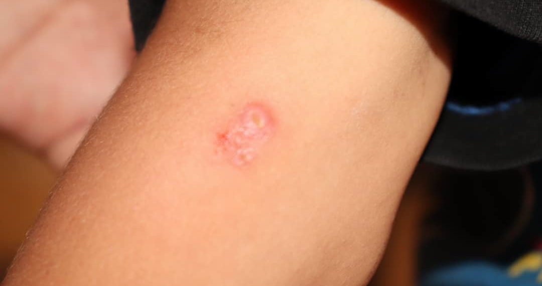 تفشي مرض “اللشمانيا” في ريف حمص