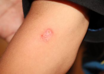 تفشي مرض “اللشمانيا” في ريف حمص