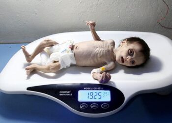 له انعكاسات خطيرة على النمو الشكلي والعقلي.. سوء التغذية يجتاح اﻷطفال في المحافظات الخاضعة لسلطة اﻷسد