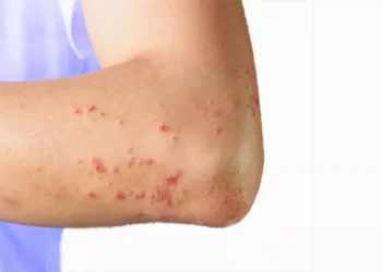 مرض نادر “قاتل وخطير” يواصل انتشاره في دمشق