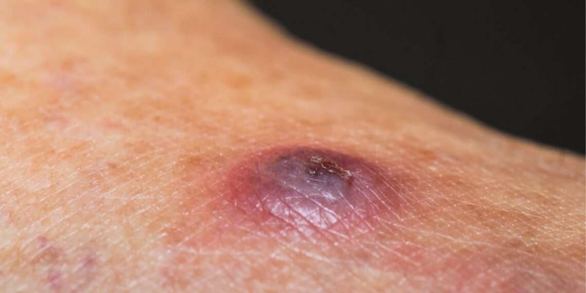 اللشمانيا تجتاح المنطقى الوسطى.. آلاف الإصابات في حماة ومسؤول طبي يكشف السبب