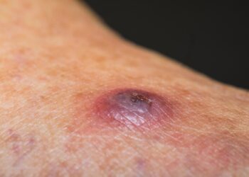 اللشمانيا تجتاح المنطقى الوسطى.. آلاف الإصابات في حماة ومسؤول طبي يكشف السبب